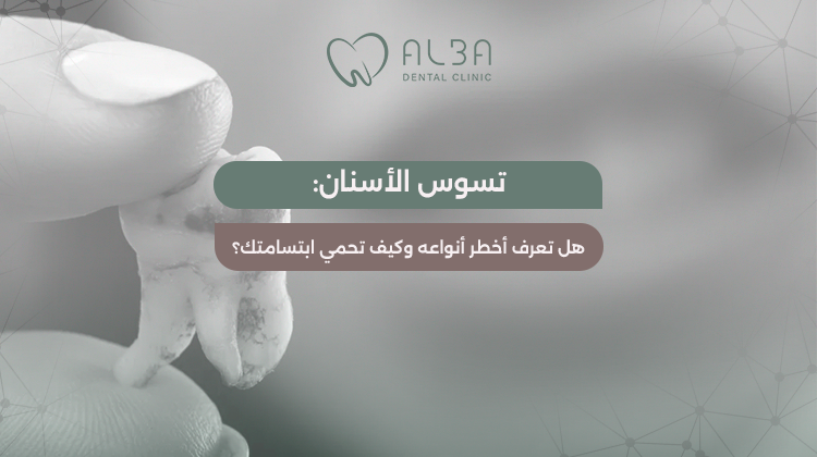 أخطر أنواع تسوس الأسنان