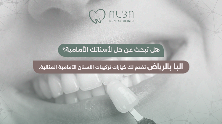أفضل أنواع تركيبات الأسنان الأمامية