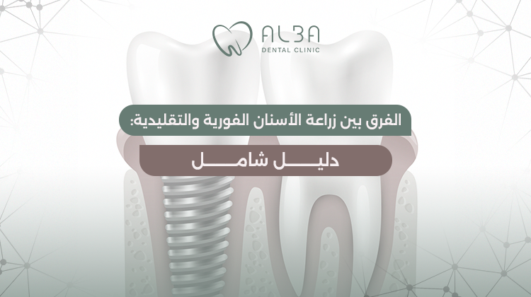 الفرق بين زراعة الأسنان الفورية والتقليدية