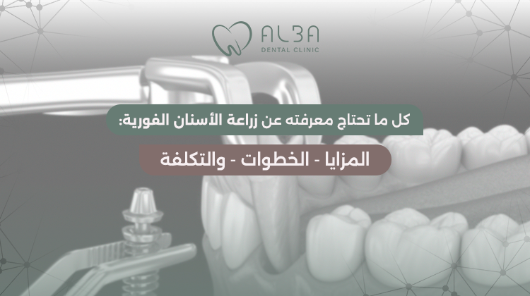 زراعة الاسنان الفورية​