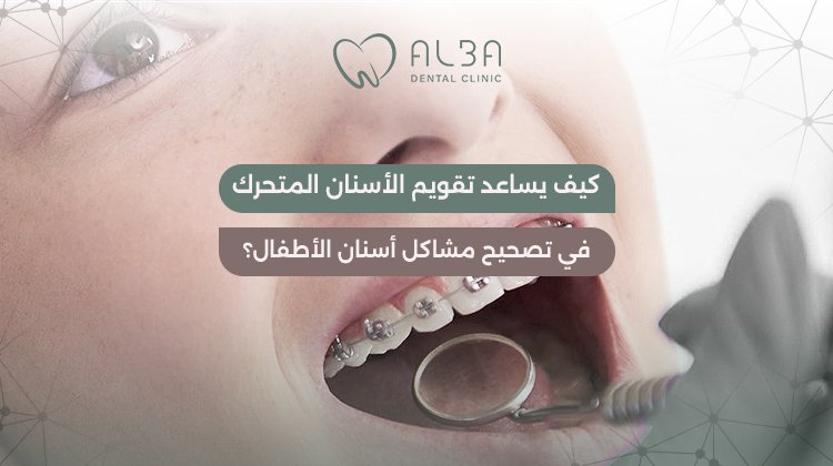 تقويم الاسنان المتحرك للاطفال