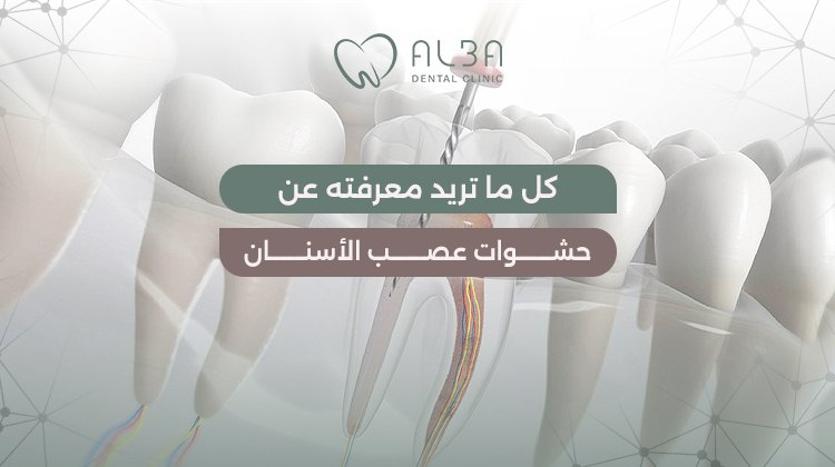حشوات عصب الاسنان