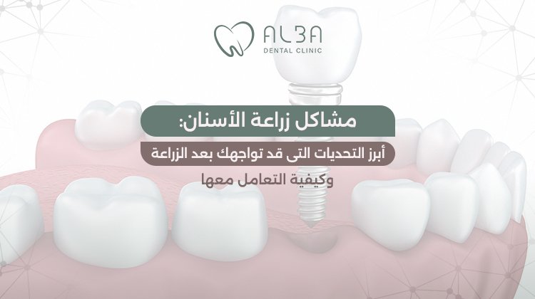 مشاكل زراعة الاسنان