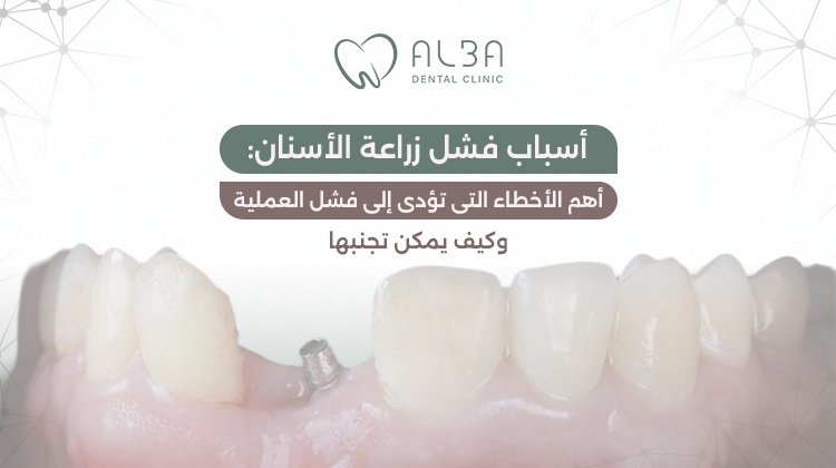 اسباب فشل زراعة الاسنان