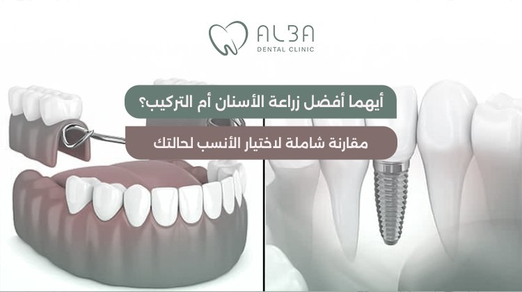 ايهما افضل زراعة الاسنان ام التركيب