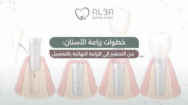 خطوات زراعة الاسنان