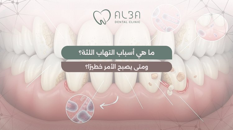 اسباب التهاب اللثة