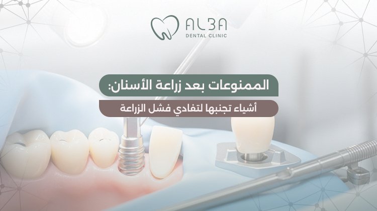 الممنوعات بعد زراعة الأسنان