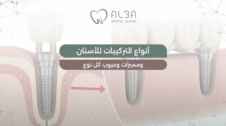 انواع التركيبات للاسنان