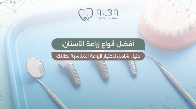 أفضل أنواع زراعة الأسنان: دليل شامل لاختيار الزراعة المناسبة لحالتك