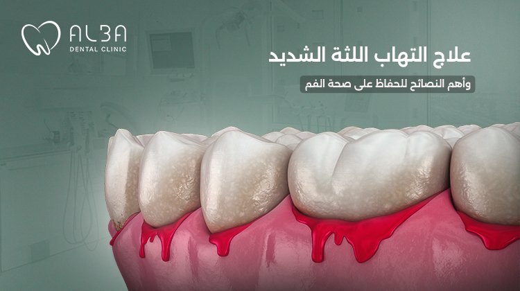 علاج التهاب اللثة