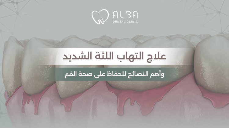 علاج التهاب اللثة الشديد وأهم النصائح للحفاظ على صحة الفم