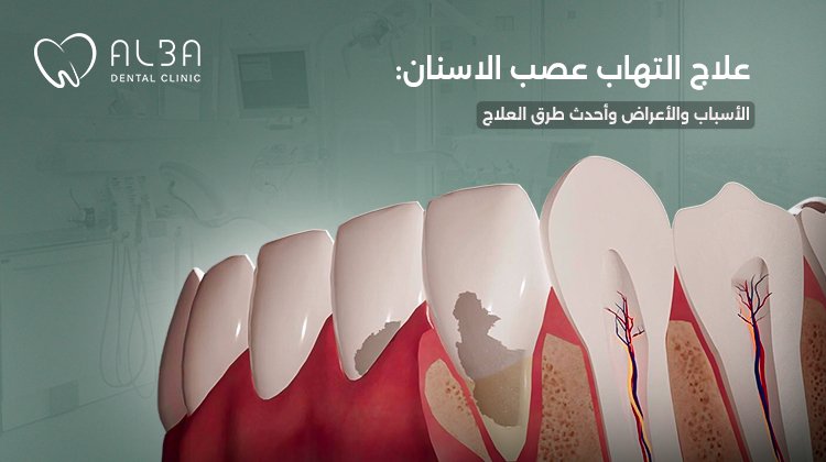 علاج التهاب عصب الاسنان