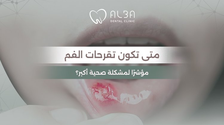علاج تقرحات الفم: متى تكون تقرحات الفم مؤشرًا لمشكلة صحية أكبر؟