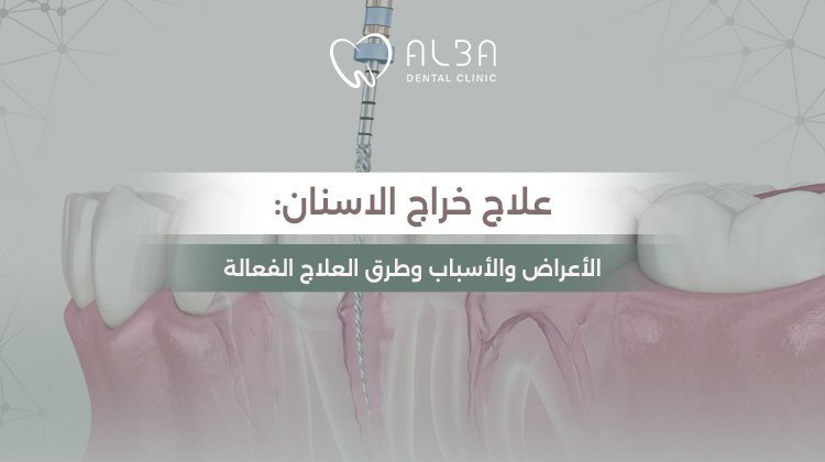 علاج خراج الأسنان: الأعراض والأسباب وطرق العلاج الفعالة