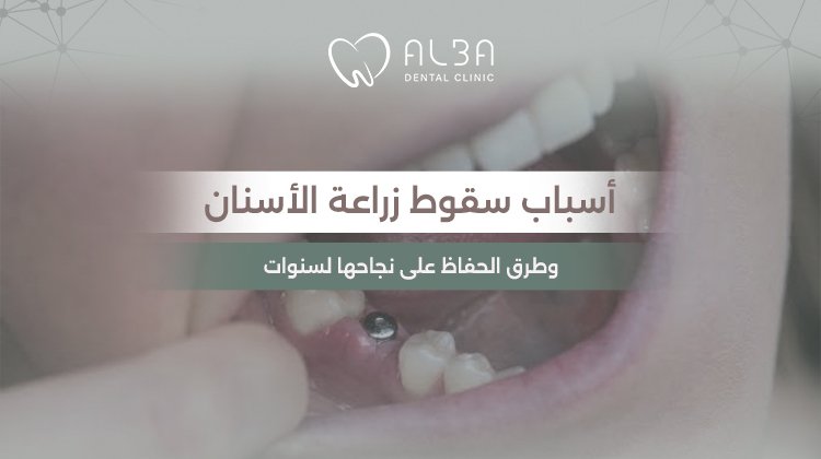اسباب سقوط زراعة الاسنان
