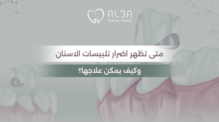 متى تظهر اضرار تلبيسات الاسنان وكيف يمكن علاجها؟