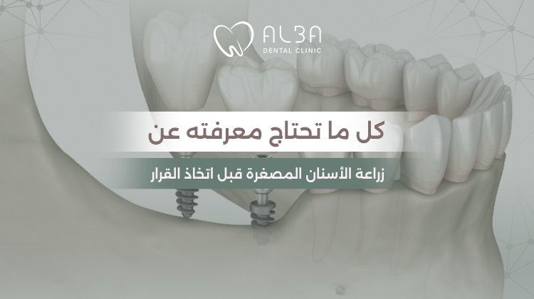 زراعة الأسنان المصغرة