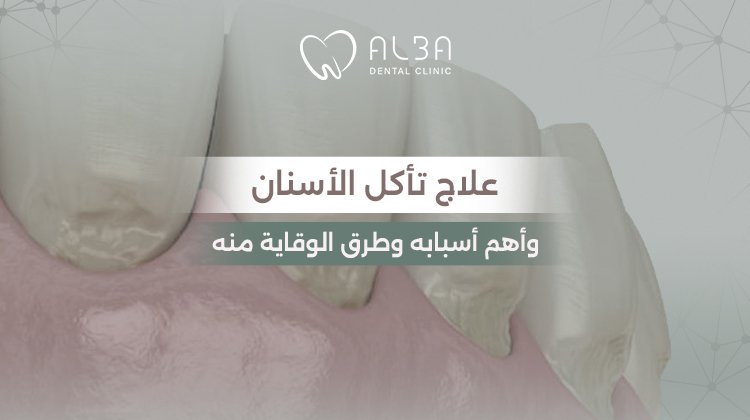 علاج تأكل الاسنان