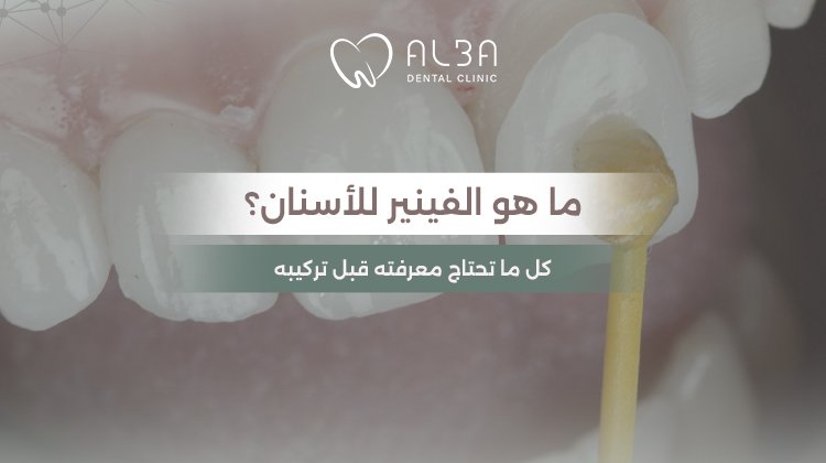 ما هو الفينير