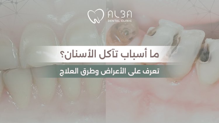 ما أسباب تآكل الأسنان؟ تعرف على الأعراض وطرق العلاج | اسباب تأكل الاسنان