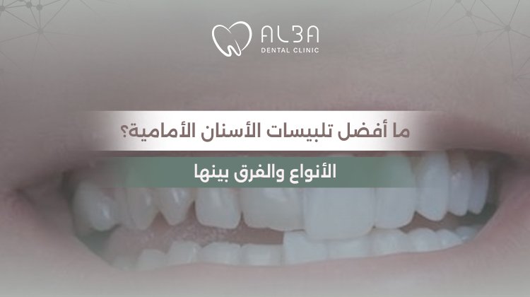 ما أفضل تلبيسات الأسنان الأمامية؟ الأنواع والفرق بينها