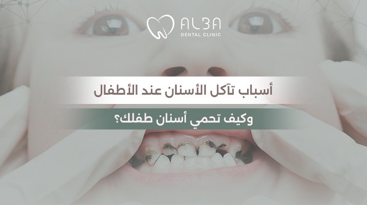 تلبيسات الاسنان للاطفال: الأنواع ومتى يحتاجها الطفل؟