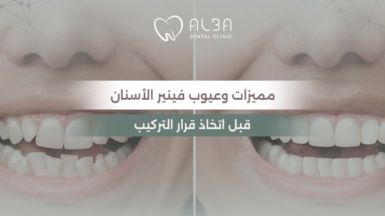 مميزات وعيوب فينير الاسنان قبل اتخاذ قرار التركيب
