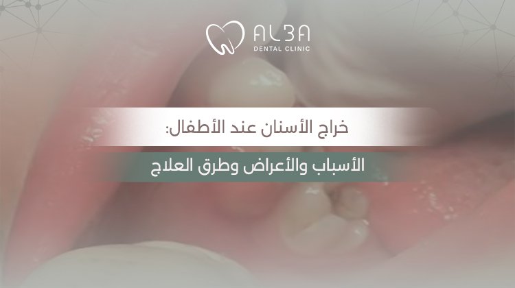 خراج الأسنان عند الأطفال: الأسباب والأعراض وطرق العلاج