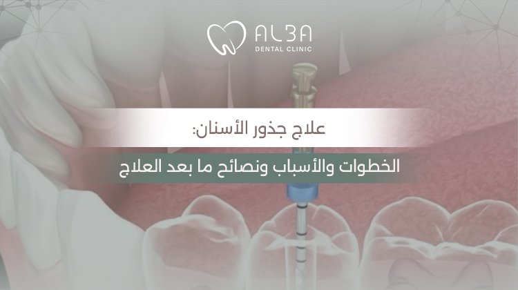 علاج جذور الاسنان: الخطوات والأسباب ونصائح ما بعد العلاج